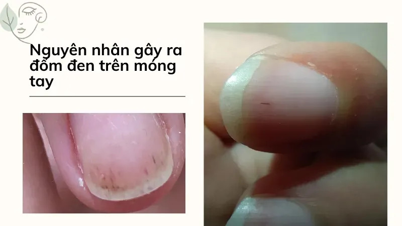 Móng tay có đốm đen nhỏ có thể do chấn thương gây tụ máu dưới móng