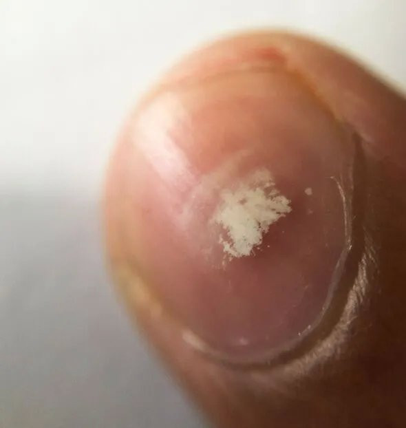 Móng tay có đốm trắng nhỏ, dấu hiệu trên móng tay thường gặp