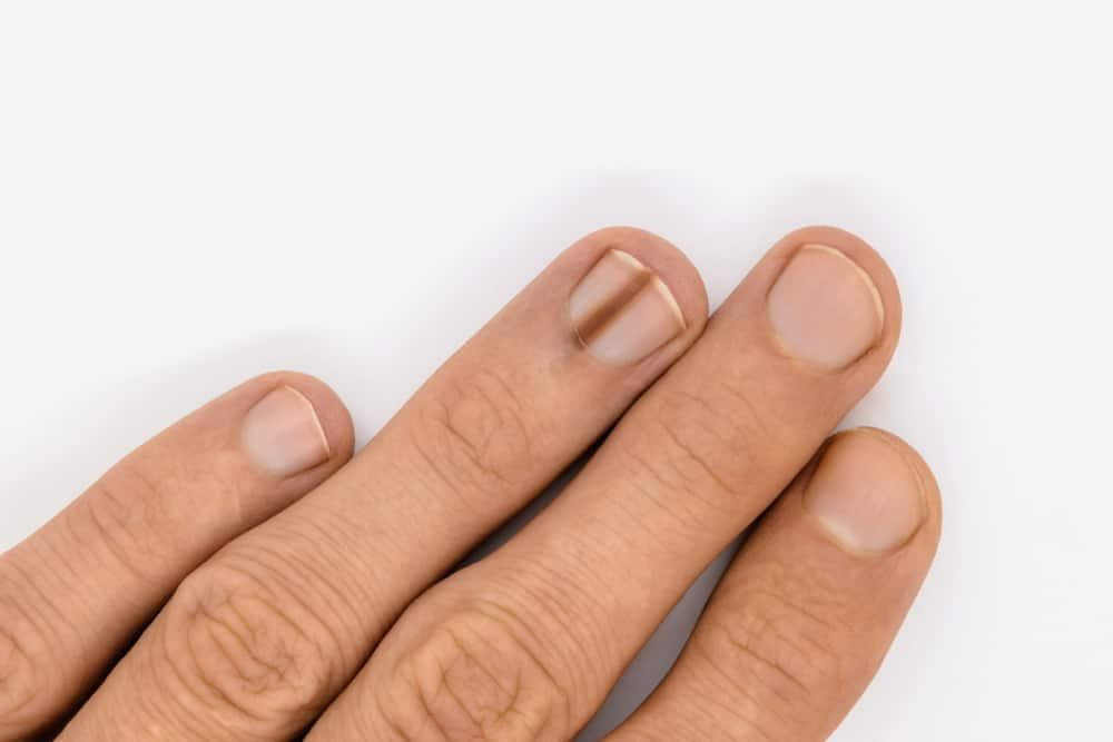 Móng tay có đường sọc dọc đen, một trong những nguyên nhân móng tay bị sọc cần chú ý, có thể là dấu hiệu bệnh lý.
