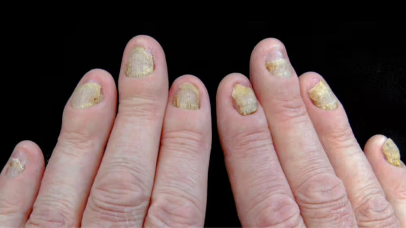 Móng Tay Bị Cong Xuống: Dấu Hiệu Sức Khỏe và Giải Pháp Chăm Sóc Móng tay có màu vàng có thể là dấu hiệu cảnh bảo các bệnh lý về phổi
