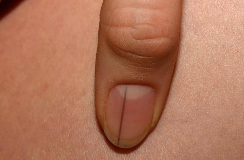 Móng tay có sọc dọc màu đen, một dấu hiệu cần thăm khám y tế sớm