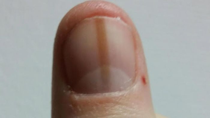 Móng tay có sọc nâu cảnh báo sức khỏe