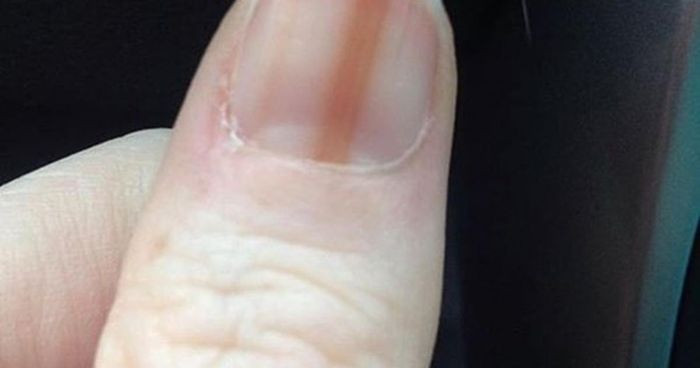 Móng tay có sọc nâu mờ do viêm gan
