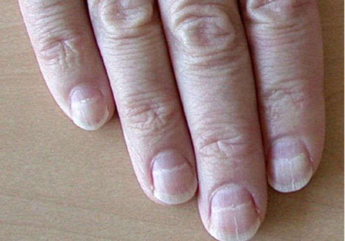 Móng tay có sọc ngang màu trắng