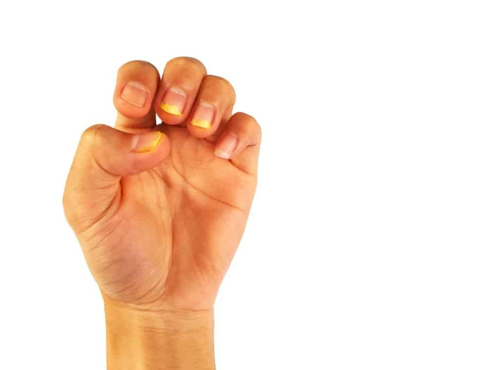 móng tay của người bình thường chuyển vàng do nấm hoặc bệnh lý