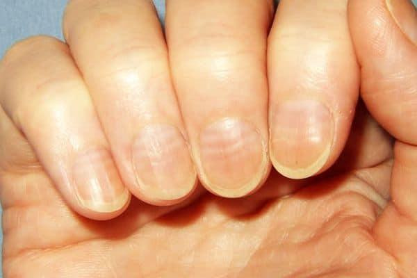 móng tay của người bình thường có sọc ngang biểu hiện thiếu chất