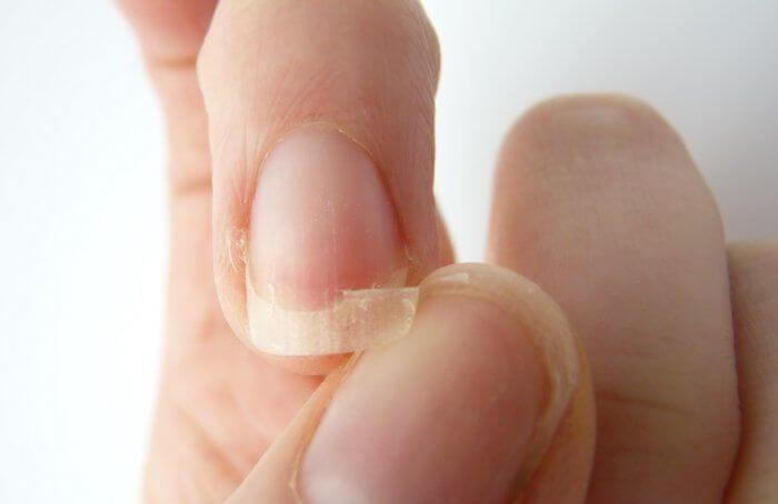 móng tay của người bình thường dễ gãy do thiếu biotin