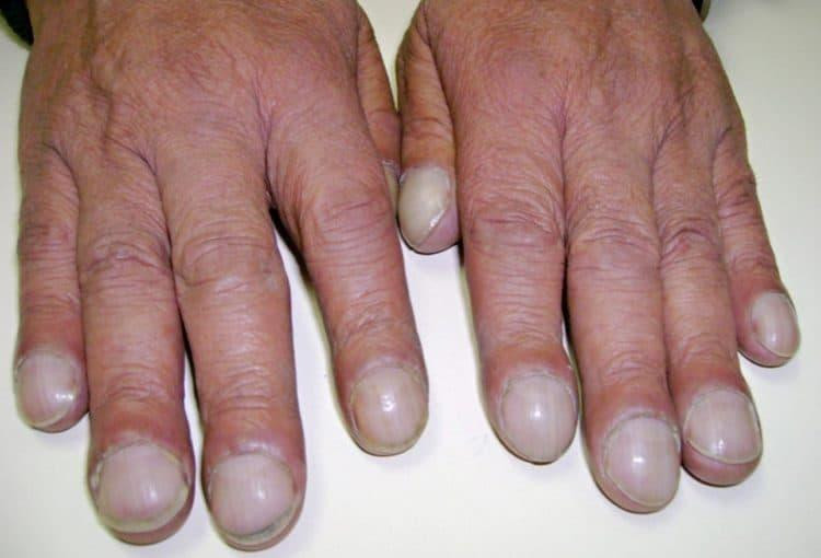 Móng tay lồi lên, biến dạng như muỗng úp ngược, có thể liên quan đến bệnh phổi