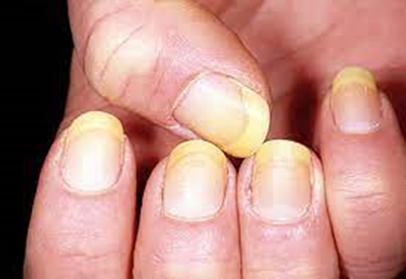 Móng tay màu vàng cảnh báo vấn đề sức khỏe tiềm ẩn