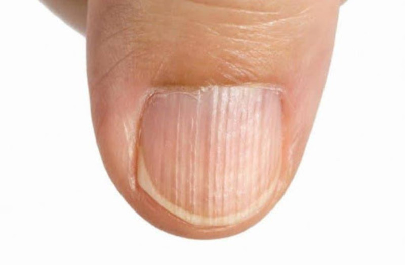 Móng tay nhiều sọc dọc, cần lưu ý đến sức khỏe tổng thể
