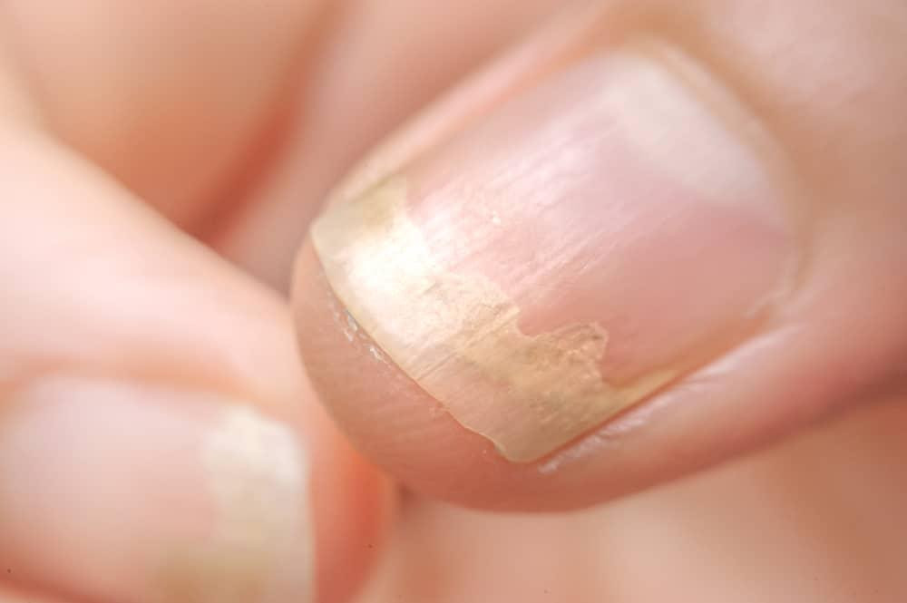 Móng tay trắng đục ở trẻ em do nhiễm nấm móng