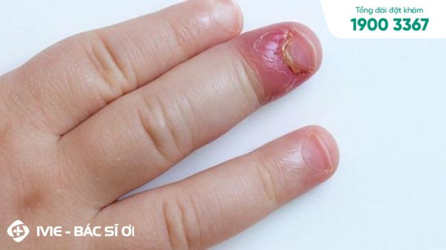 Móng tay trẻ bị sưng viêm có thể gây bong móng