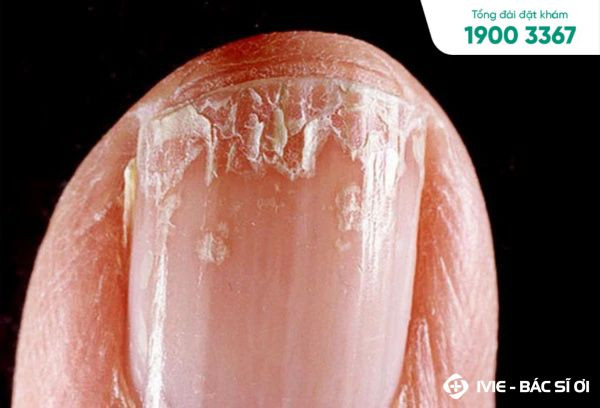 Móng tay trẻ em bị bong tróc với dấu hiệu tách lớp rõ ràng