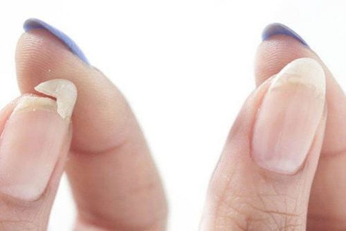 Một bàn tay đang gặp phải tình trạng móng tay giòn dễ gãy với nhiều vết nứt và khô ráp