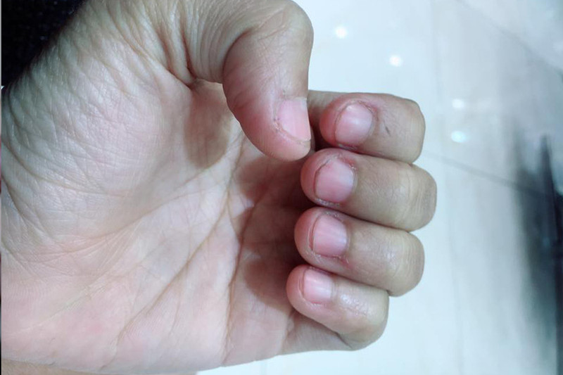 Một bàn tay đang suy tư, gợi lên thói quen cắn móng tay và những lo lắng về sức khỏe tiềm ẩn, bao gồm cả tin đồn cắn móng tay bị tim