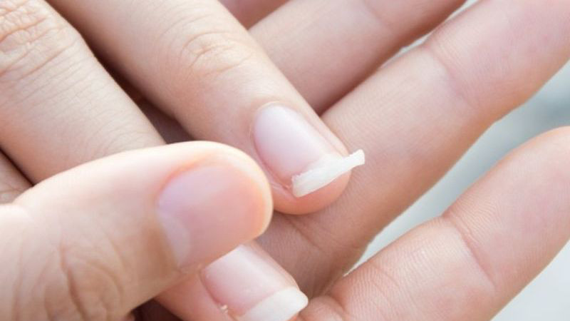 Một số người có cơ địa móng yếu và dễ gãy
