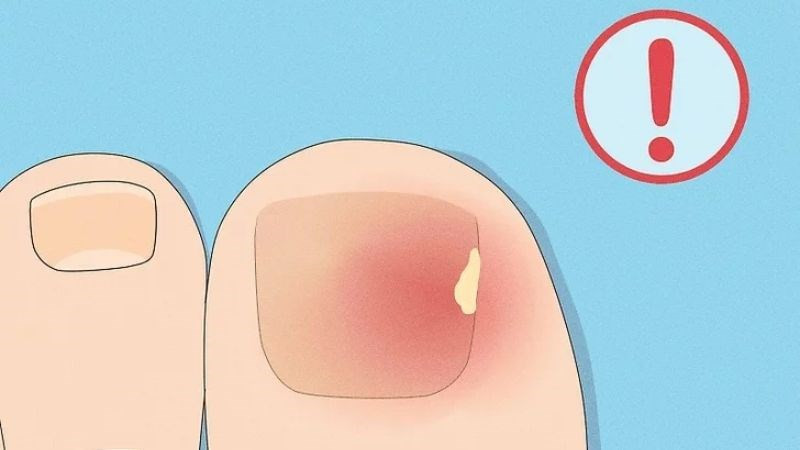 Ngón chân bị sưng đỏ, dấu hiệu cảnh báo nhiễm trùng móng cần được thăm khám y tế