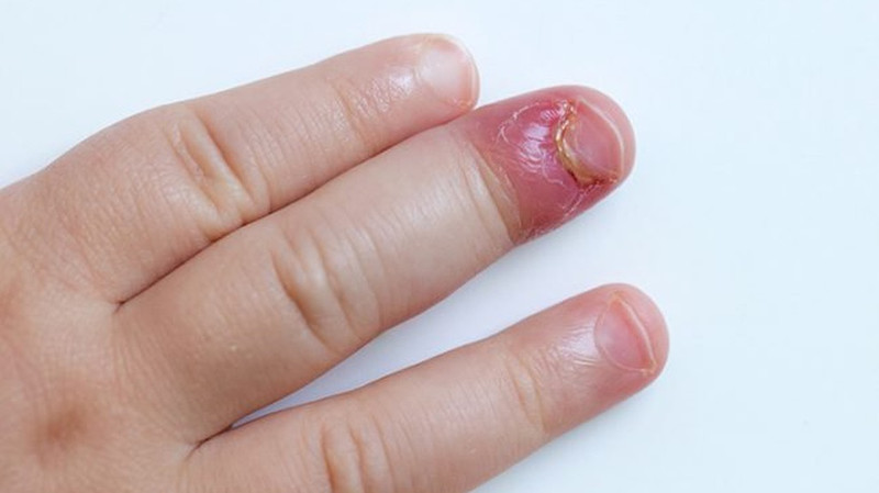Ngón tay bị viêm nhiễm gây nhức khoé móng tay do vi khuẩn