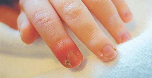 Người đang sờ vào móng tay bị u cuộn mạch dưới móng tay, thể hiện sự đau đớn
