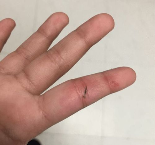Người lớn đang dùng nhíp khử trùng để lấy dằm cẩn thận từ ngón tay của một đứa trẻ, tập trung vào việc vệ sinh trước khi loại bỏ mảnh dằm