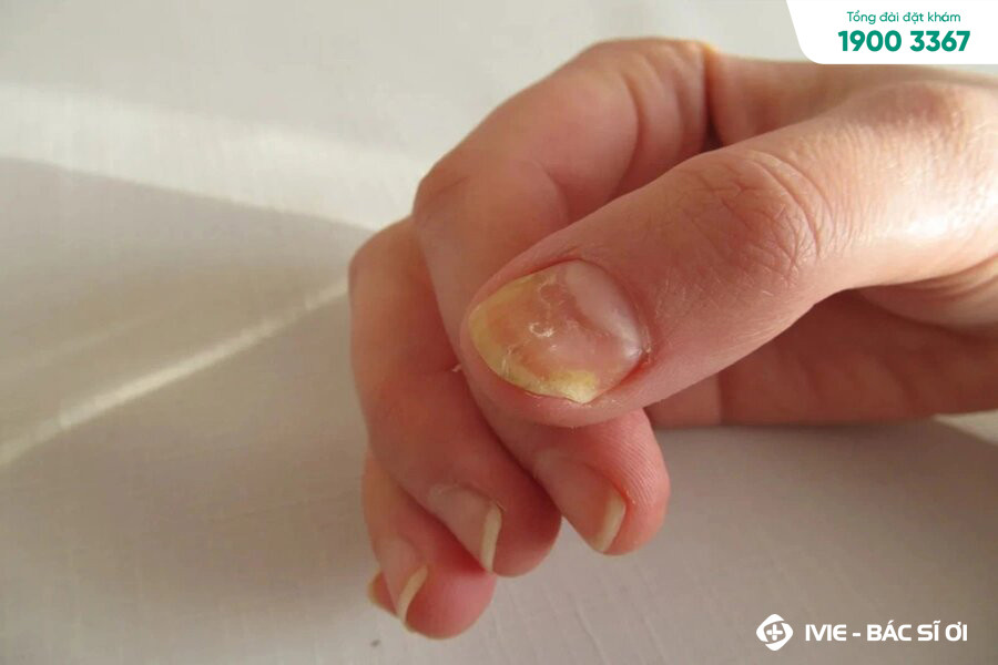 Nhận biết dấu hiệu nấm móng chân ở trẻ em có thể bị sần sùi
