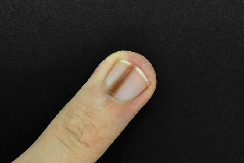 Những biến đổi về hình dáng và màu sắc của móng tay HIV giai đoạn đầu cần được lưu ý