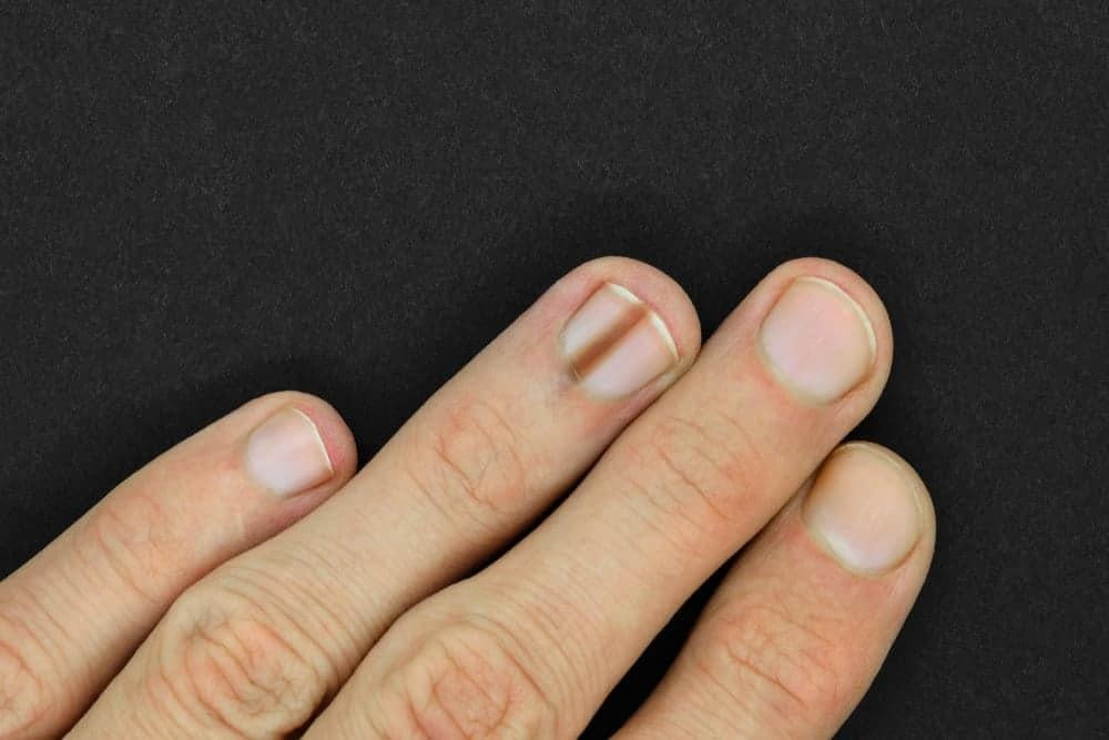 Phân biệt tụ máu bầm ở móng chân với dấu hiệu u hắc tố