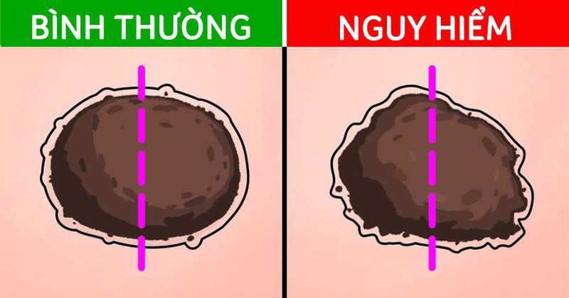 Phát hiện sớm nốt ruồi bất đối xứng ở móng tay