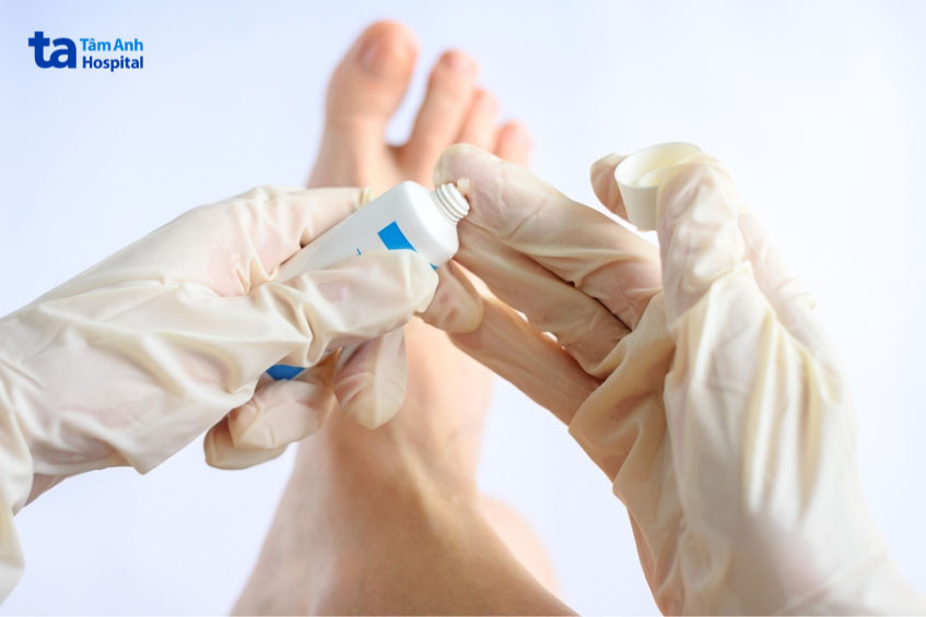 Phương pháp bôi thuốc điều trị nấm móng chân tại nhà