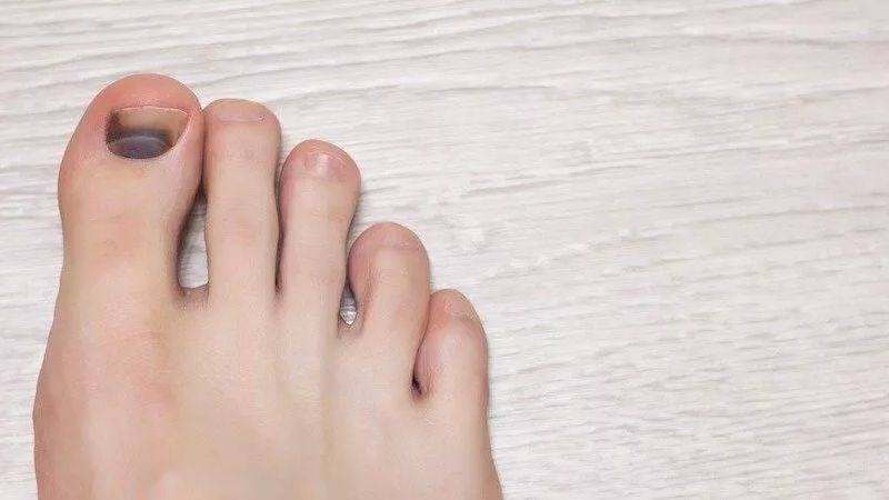 Quá trình tự phục hồi của móng chân bị hư tổn sau chấn thương, cho thấy móng mới đang dần mọc lên