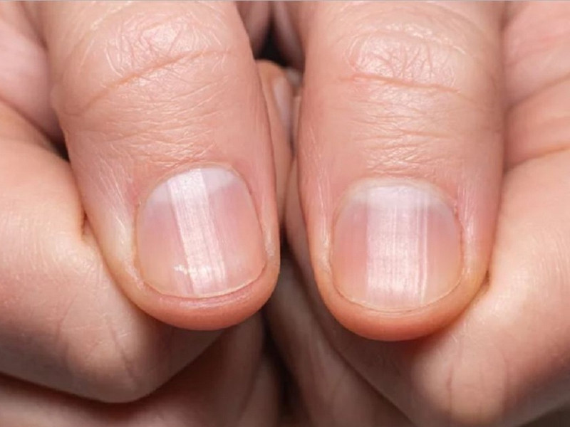 Quan sát móng tay để nhận biết sớm các dấu hiệu móng tay tím do bệnh tim