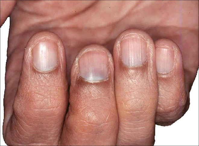 Quầng móng tay bị đen có thể là dấu hiệu ngộ độc kim loại nặng cần thăm khám