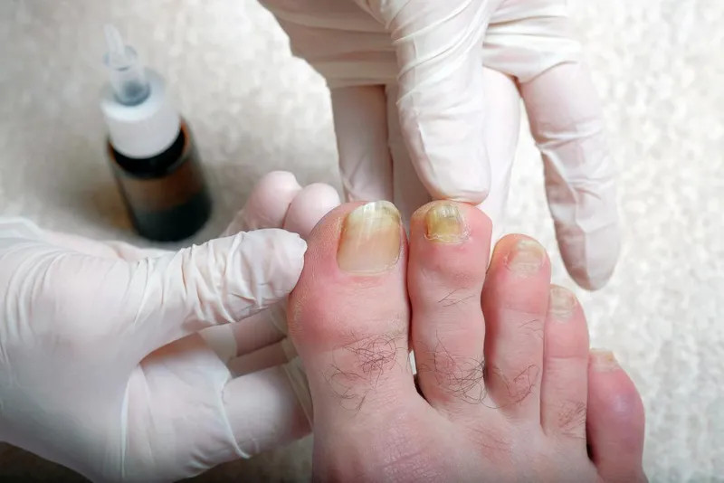 Sơ cứu móng chân bị tím bằng cách chườm đá lạnh