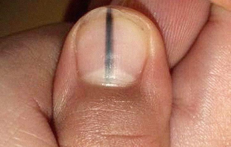sọc đen dọc trên móng tay của người bình thường cảnh báo sức khỏe