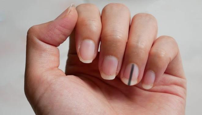 Sọc đen trên móng tay cảnh báo dấu hiệu móng tay bị ung thư