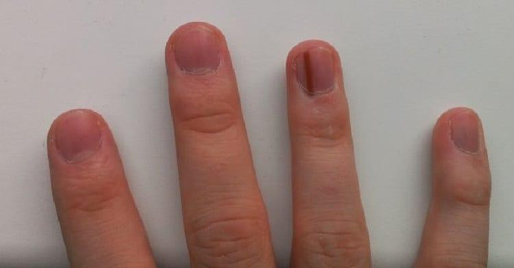 sọc dọc đỏ trên móng tay của người bình thường liên quan bệnh tim
