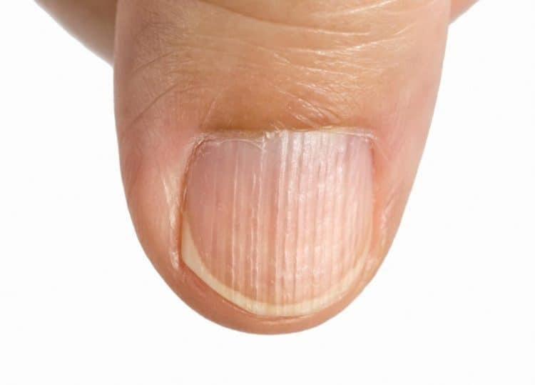 sọc dọc trên móng tay của người bình thường theo tuổi tác