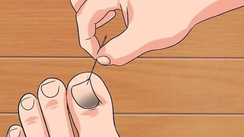 Sử dụng thuốc mỡ kháng sinh cho móng chân bị hỏng