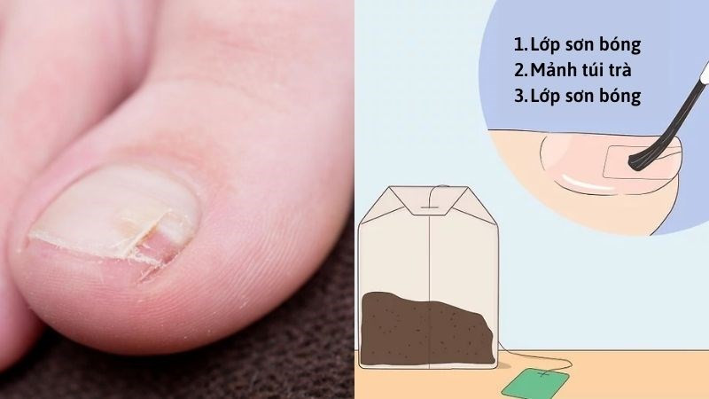 Sử dụng túi trà để hỗ trợ phục hồi móng chân bị gãy, một phần của cách dưỡng móng chân