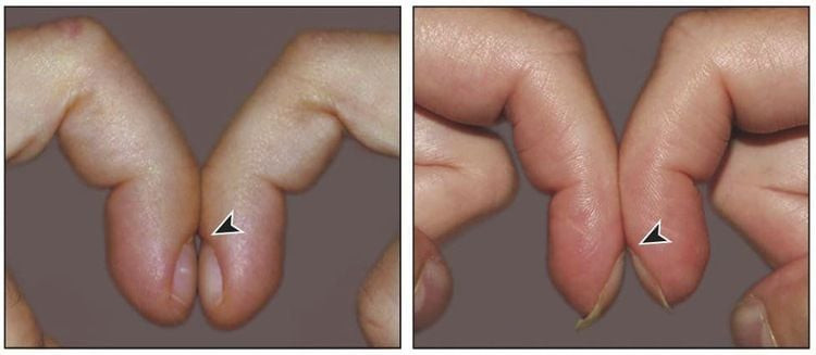 Sự khác biệt giữa móng chân dùi trống và móng khỏe mạnh