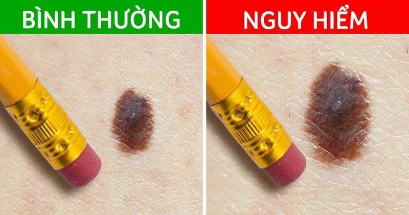 Sự thay đổi hình dạng và kích thước của nốt ruồi móng tay