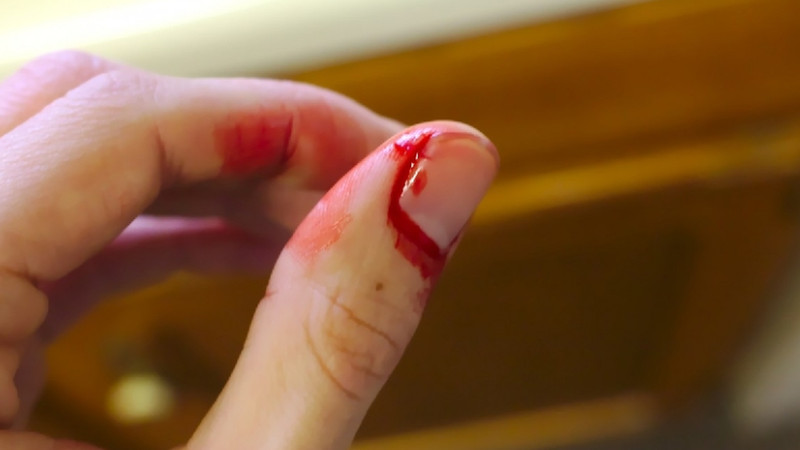 Thăm khám bác sĩ khi móng tay bị bong không rõ nguyên nhân