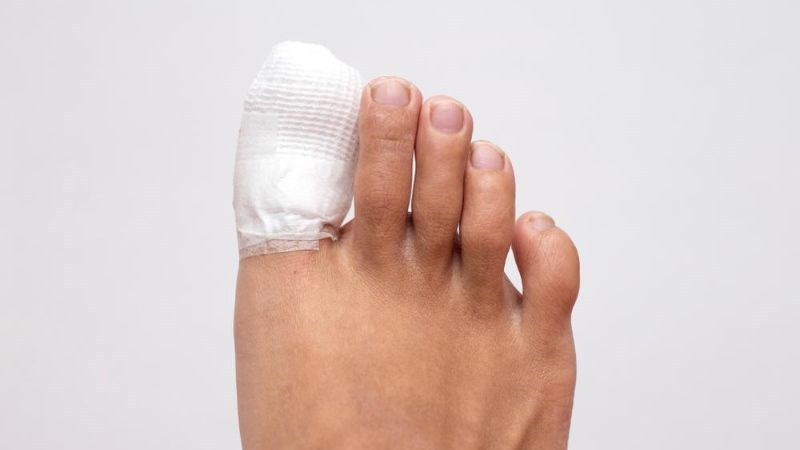 Thay băng thường xuyên giúp vết thương thông thoáng, hỗ trợ cách dưỡng móng chân