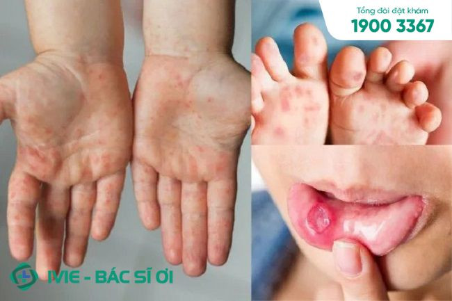 Thay móng tay ở trẻ em do biến chứng lành tính của bệnh tay chân miệng