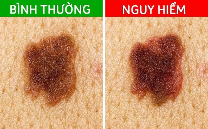 Theo dõi đường kính nốt ruồi lớn ở móng tay