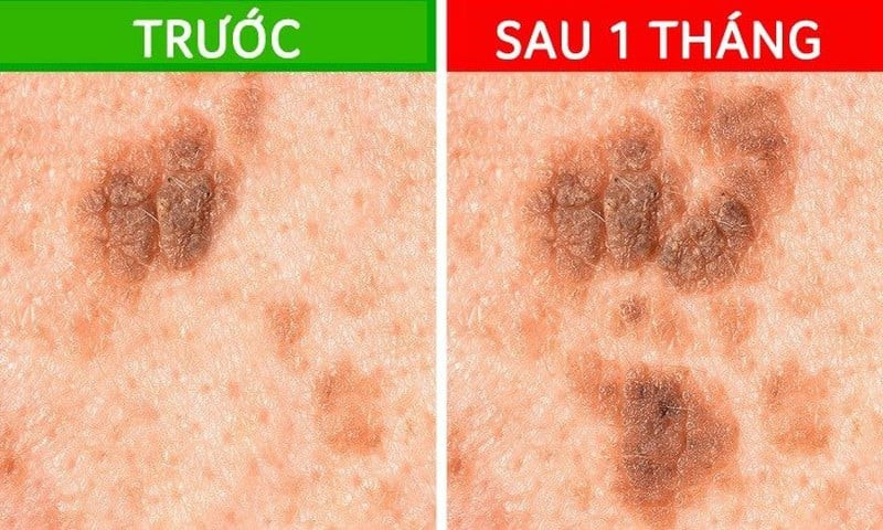 Nốt ruồi trong móng tay: Dấu hiệu nguy hiểm cần biết Theo dõi sự thay đổi hình dạng và kích thước của nốt ruồi theo thời gian