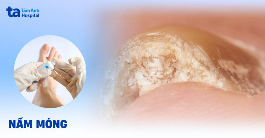 Tổng quan về nấm móng chân và các loại nấm gây bệnh