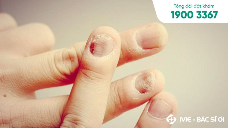 Trẻ bị thay móng tay do nhiều nguyên nhân