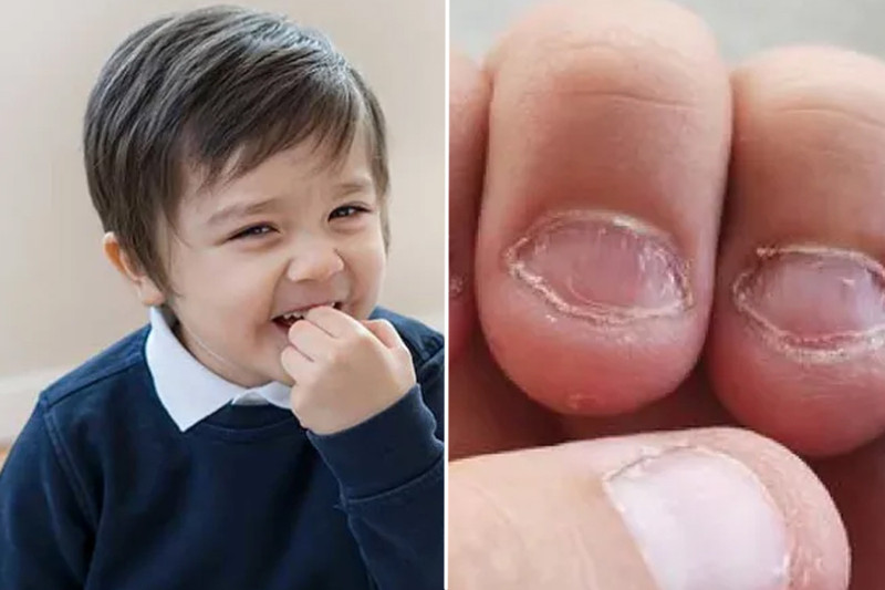 Trẻ cắn móng tay thiếu chất gì do thiếu sắt, canxi, vitamin D