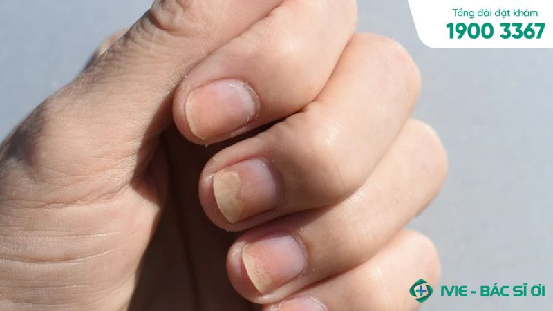 Trẻ em bị bong tróc móng tay do thiếu hụt dinh dưỡng